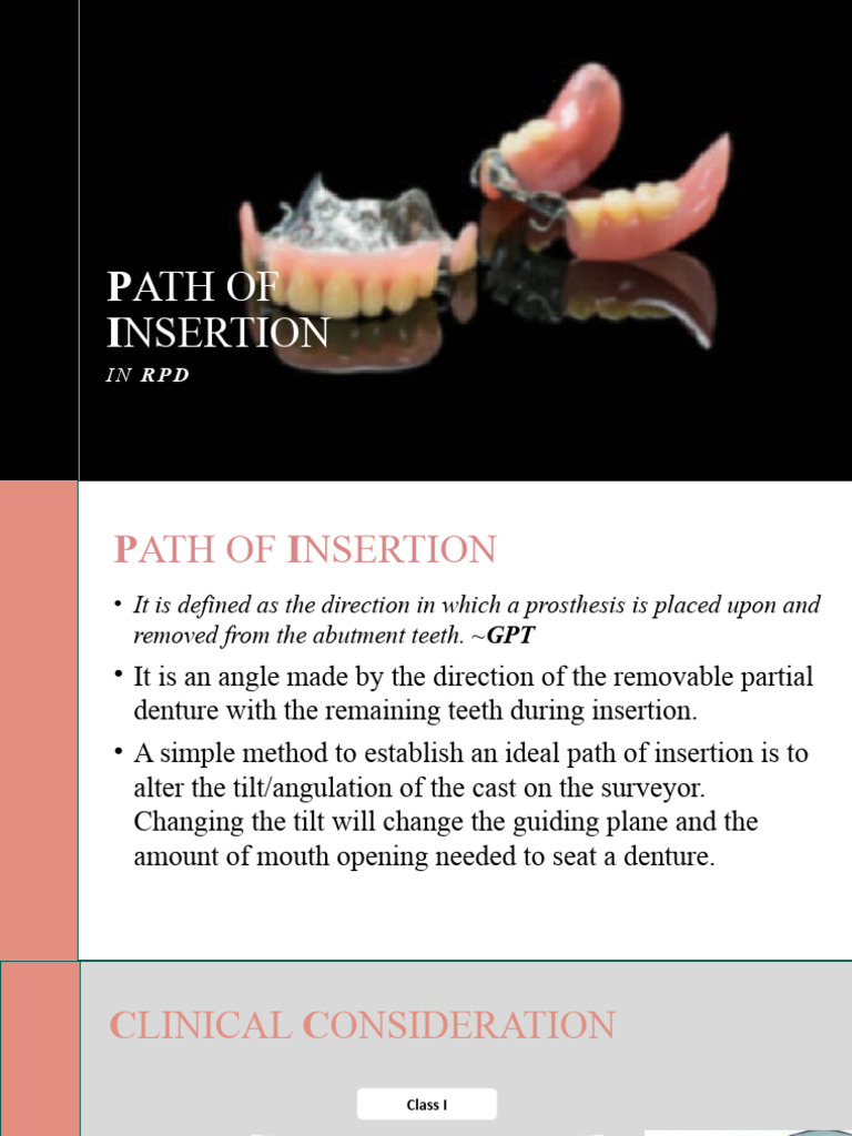 Path of Insertion in RPD Design | PDF | Dental Anatomy | Dentistry Branches