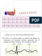 Arritmias