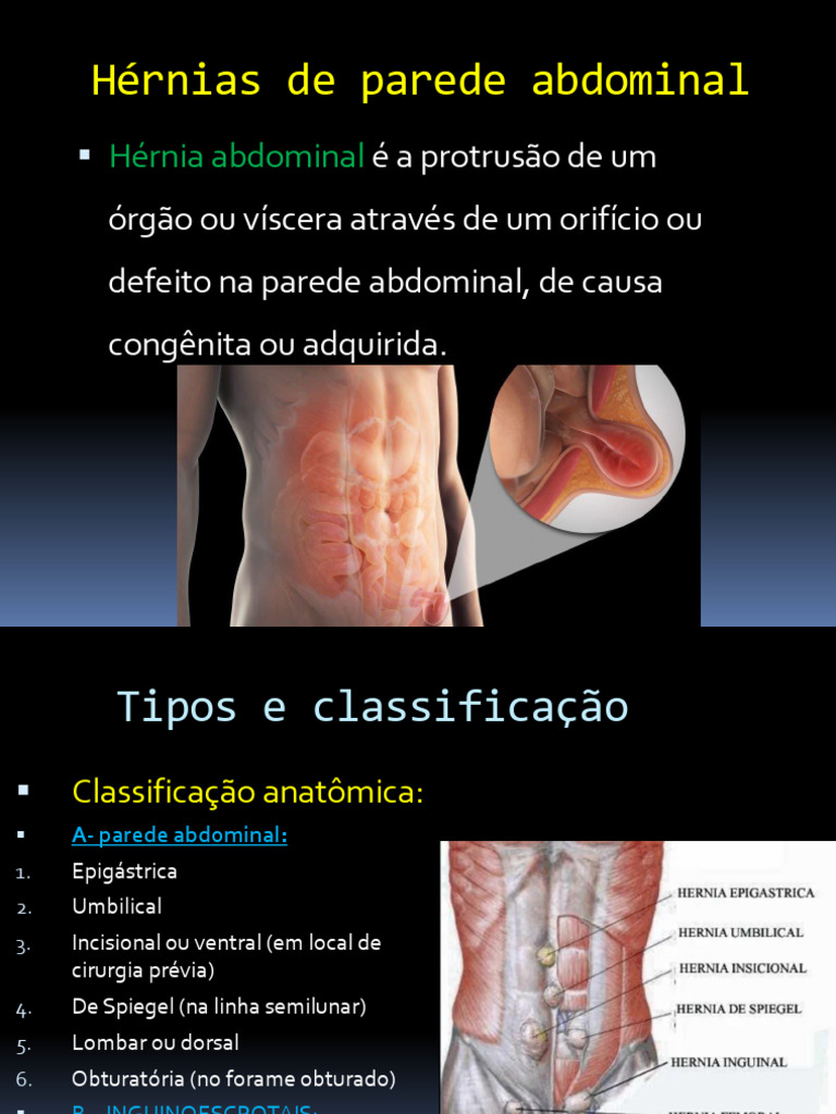 Classificação de Hérnias Abdominais | PDF | Anatomia