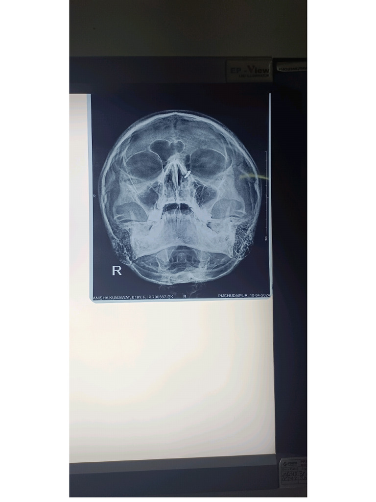 FRONTAL SINUSITIS XRAY PNS PDF