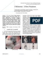 Esophageal Melanoma - A Rare Neoplasm