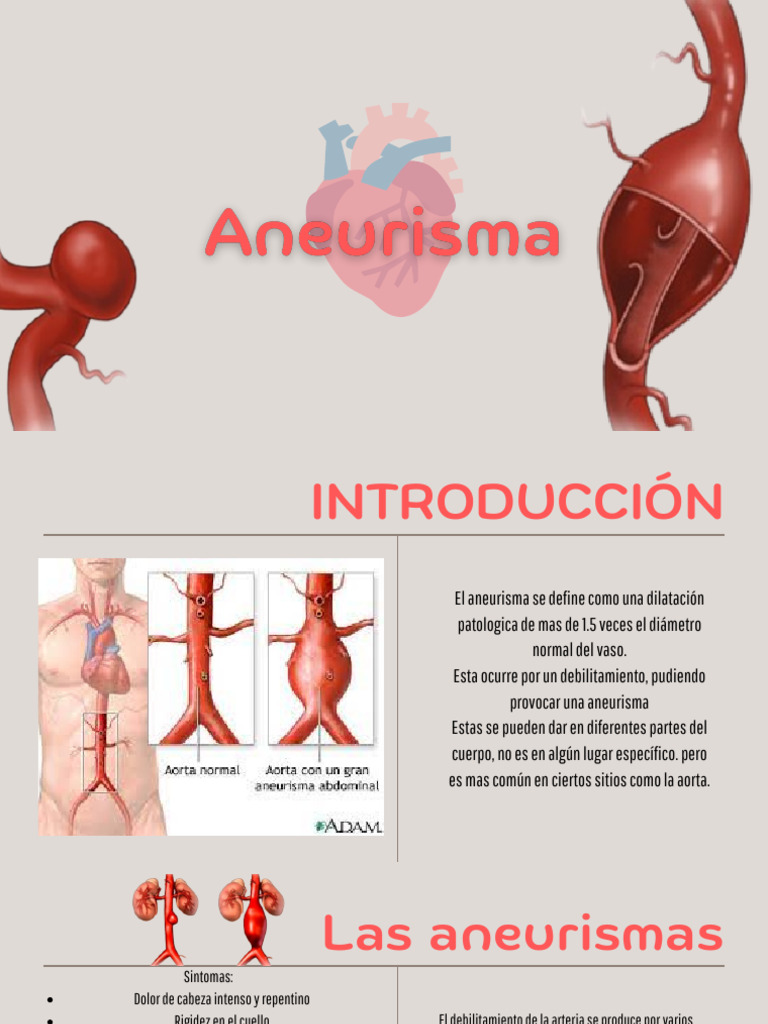 Causas y tipos de aneurismas | PDF | Medicina CLINICA | Enfermedades y ...