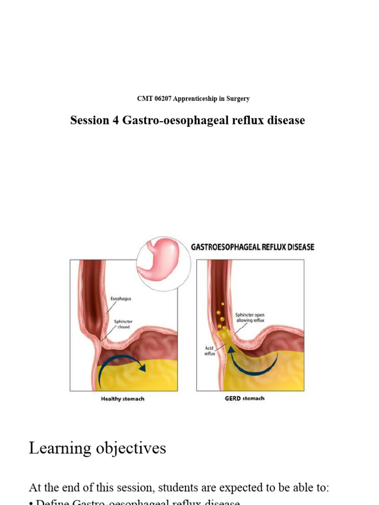 Understanding Gastro-Oesophageal Reflux Disease | PDF ...