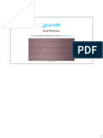 Atrial Fibrillation