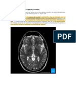 Resonancia Magnética Cerebral Normal