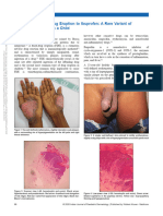 Psoriasiform Fixed Drug Eruption To Ibuprofen A.22