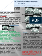 Alcoolisation Des Métastases Osseuses