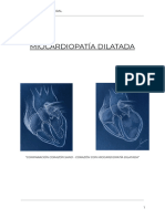 Miocardiopatía Dilatada