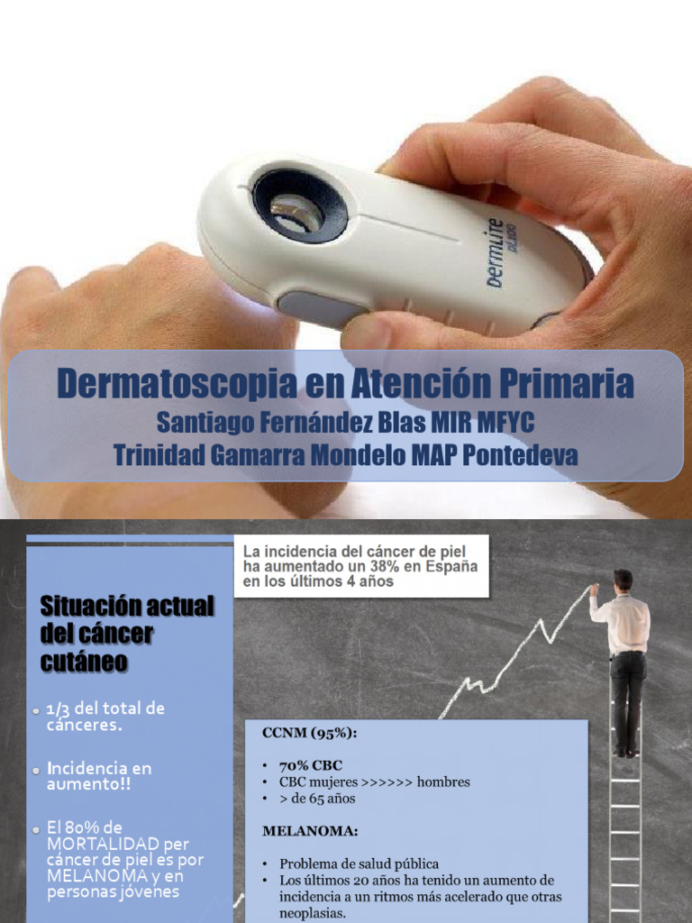 Dermatoscopia en Atención Primaria | PDF | Melanoma | Cáncer de piel