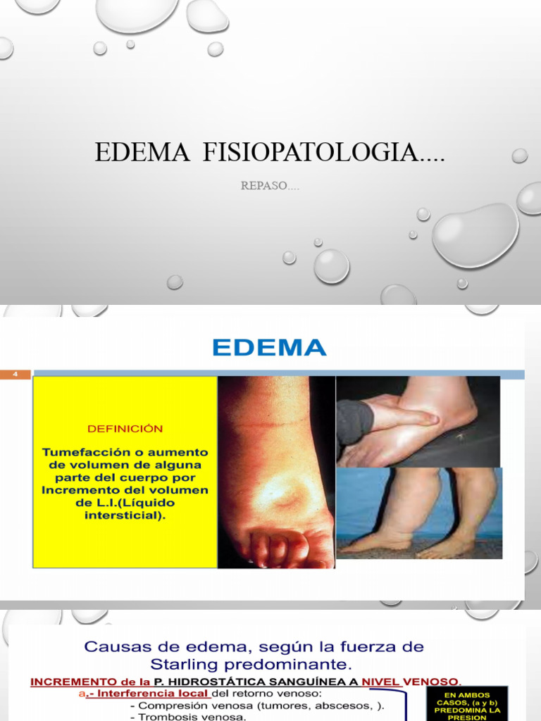 Edema | PDF | Edema | Especialidades Medicas