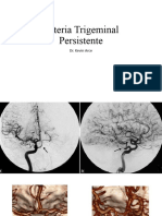 Arteria Trigeminal Persistente