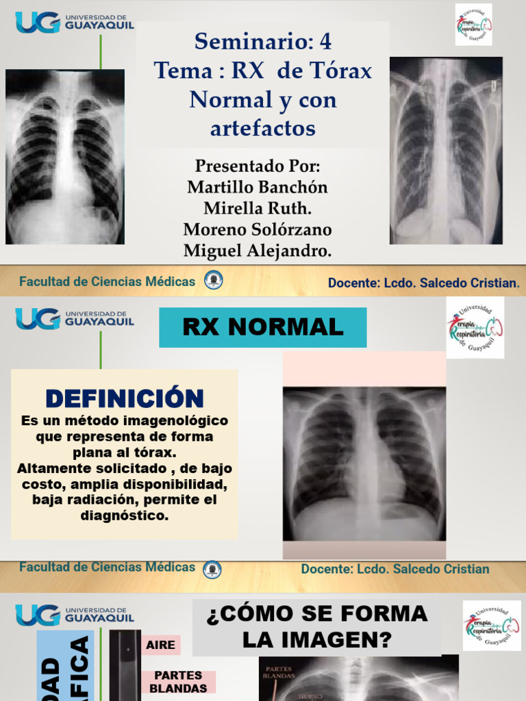 Radiografía de Tórax: Normal y Artefactos | PDF | Corazón | Aorta