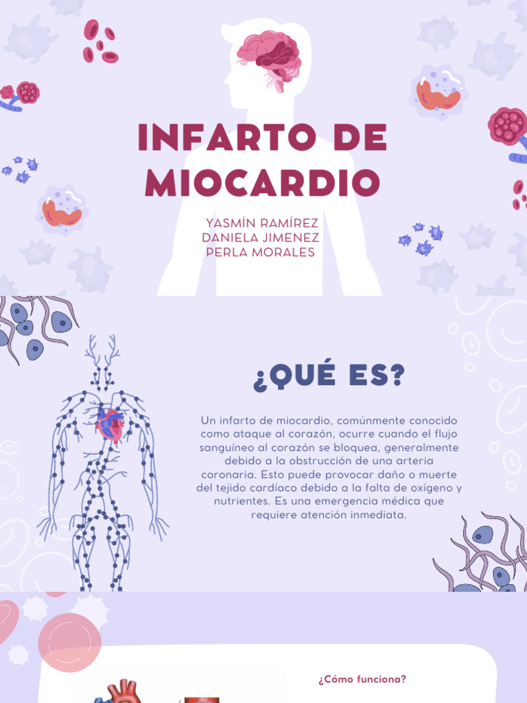 Infarto de Miocardio | PDF | Infarto de miocardio | Enfermedades ...