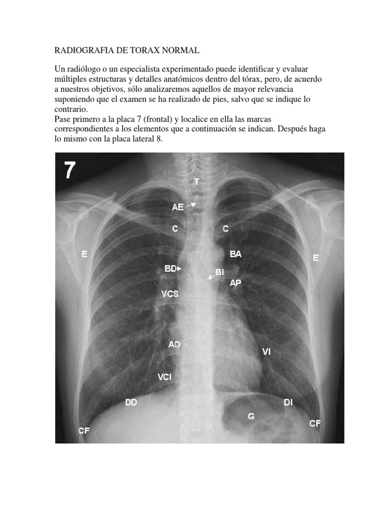 Radiografía de Tórax Normal | PDF | Pulmón | Tórax