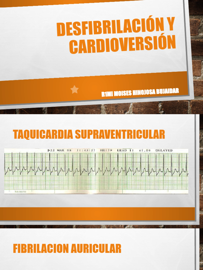 Desfibrilación y Cardioversión en Taquicardias | PDF | Reanimación ...