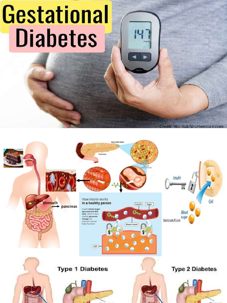 GESTATIONAL-DIABETES | Download Free PDF | Gestational Diabetes | Diabetes