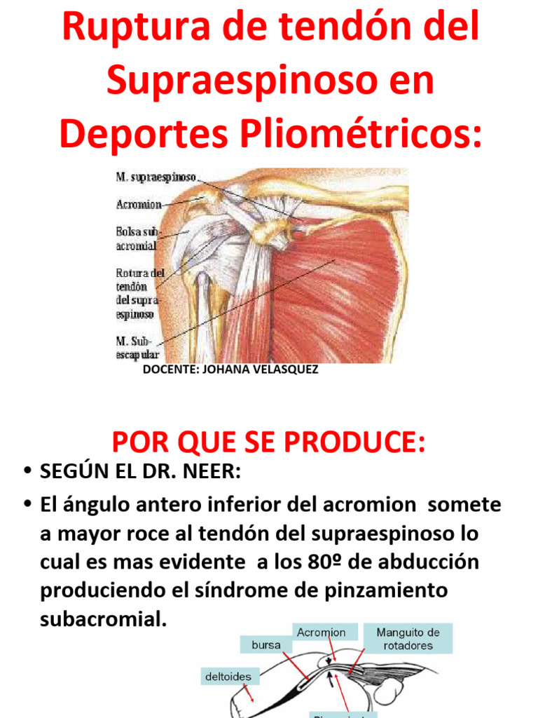 Ruptura del Tendón Supraespinoso | PDF | Hombro | Articulación