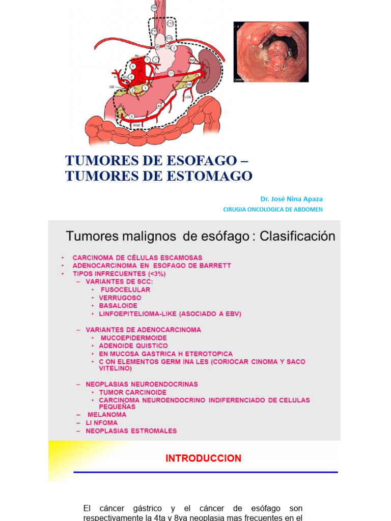 Cirugía Oncológica: Tumores Esofágicos y Gástricos | PDF | Cáncer ...