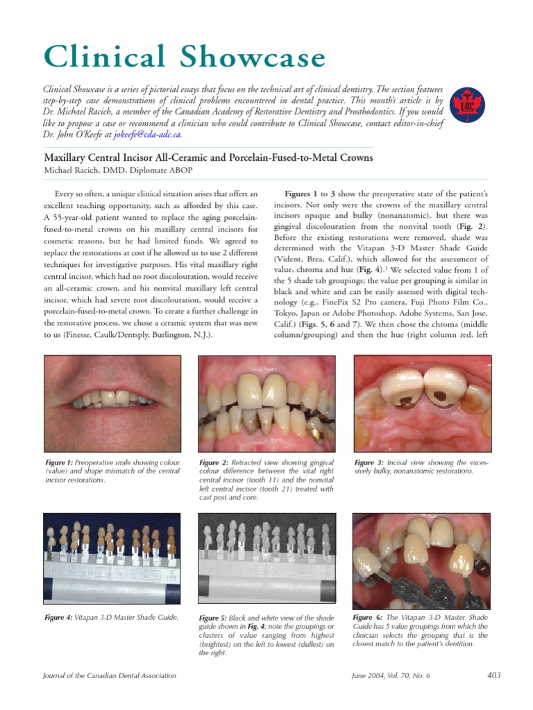 Maxillary Central Incisor Crown Techniques | PDF