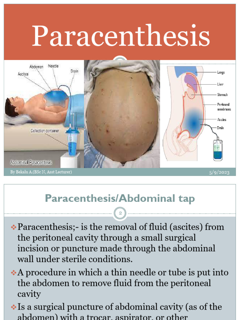 Paracentesis Procedure Overview | PDF | Cerebrospinal Fluid | Medical ...