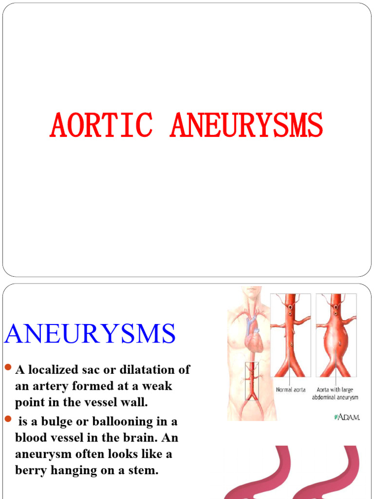 Aortic aneurysms 4 download free pdf cardiovascular diseases