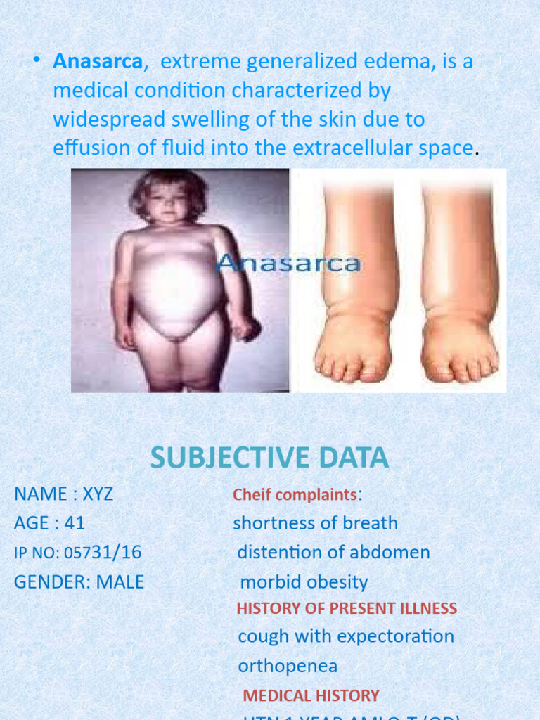 Understanding Anasarca and Its Treatment | PDF | Edema | Medical ...