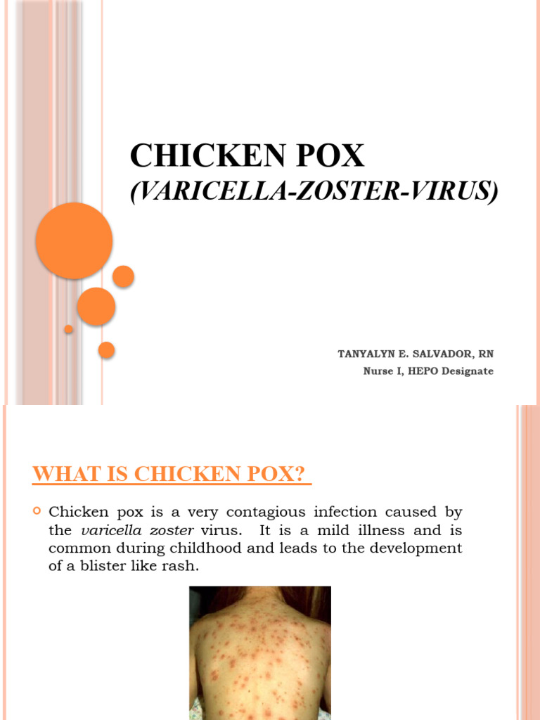 Chicken Pox Powerpoint | PDF | Virology | Diseases And Disorders