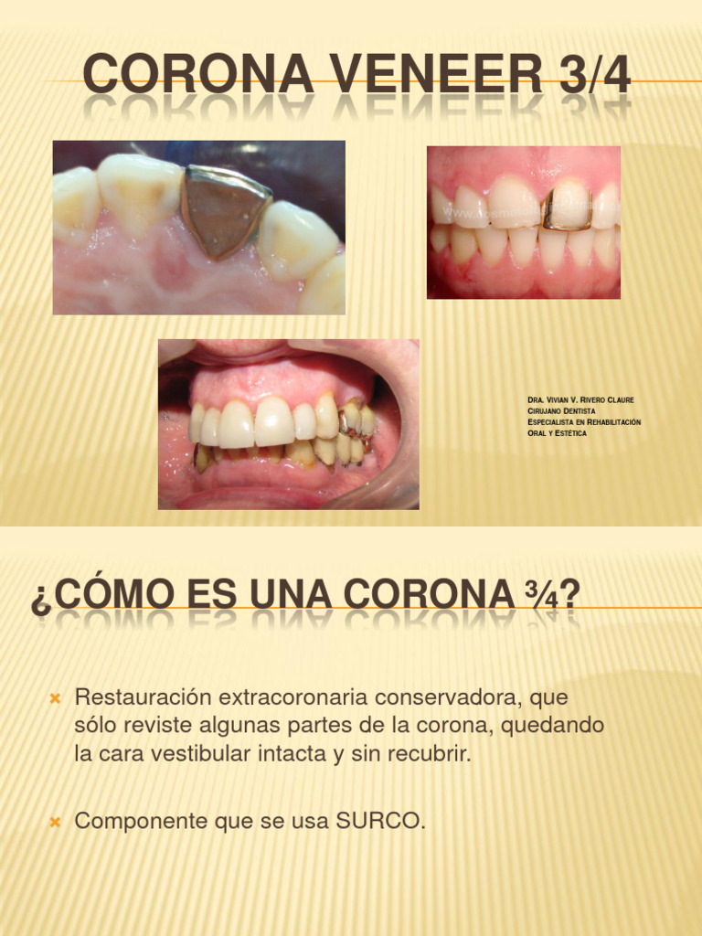 Corona Veneer 3/4: Guía de Preparación | PDF | Ciencia y matemáticas