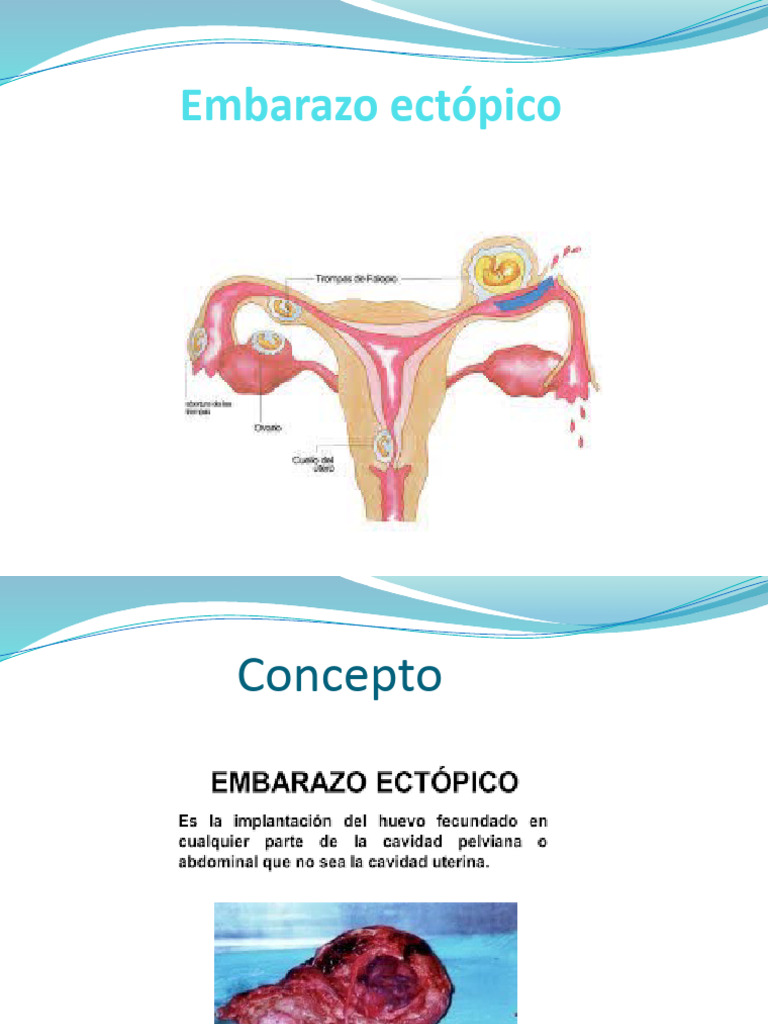 Embarazo Ectópico: Causas y Tratamientos | PDF | El embarazo ...
