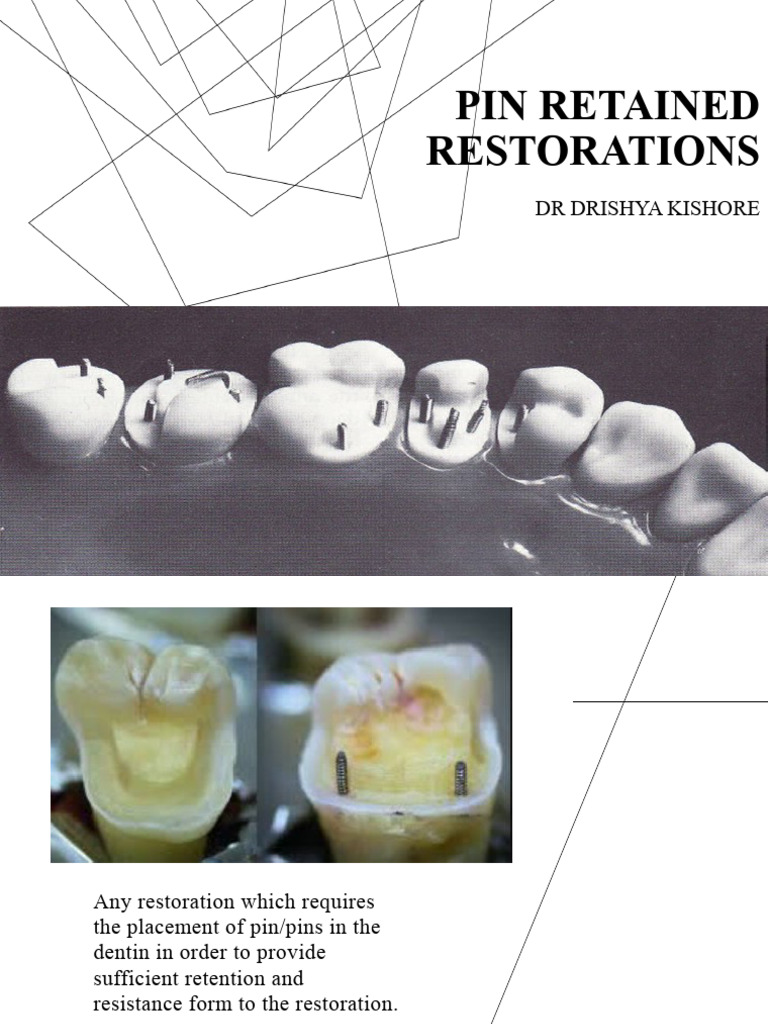 Pin Retained Dental Restorations Guide | PDF | Dentin | Tooth