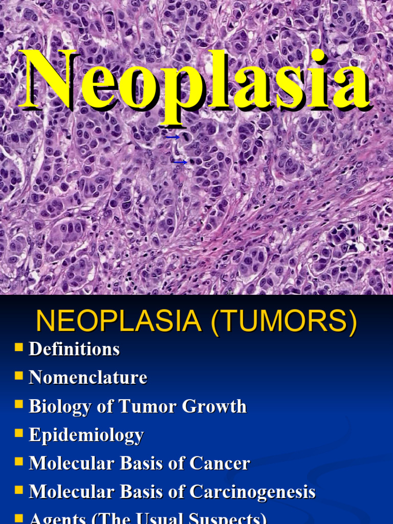 Neoplasia Download Free Pdf Neoplasms Cancer
