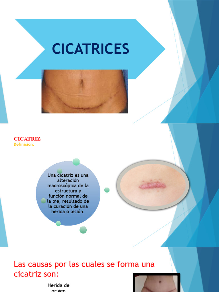 Cicatriz | PDF | Herida | Cicatriz