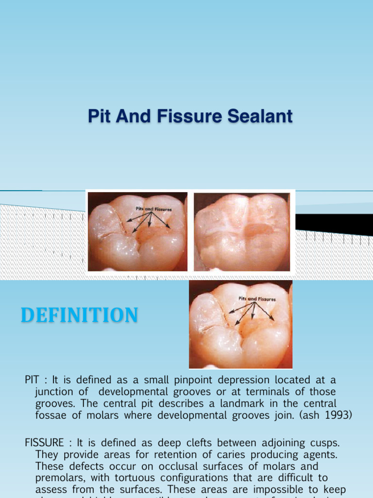 Dental Sealants for Caries Prevention | PDF | Human Tooth | Dental Anatomy