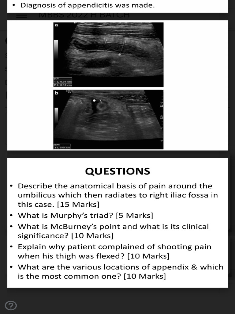 CBD Appendicitis | PDF
