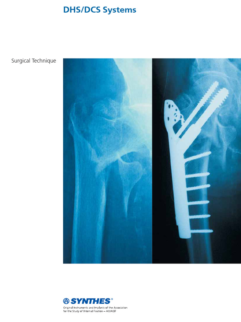 DHS vs. DCS Surgical Techniques Guide | PDF | Hip | Musculoskeletal System