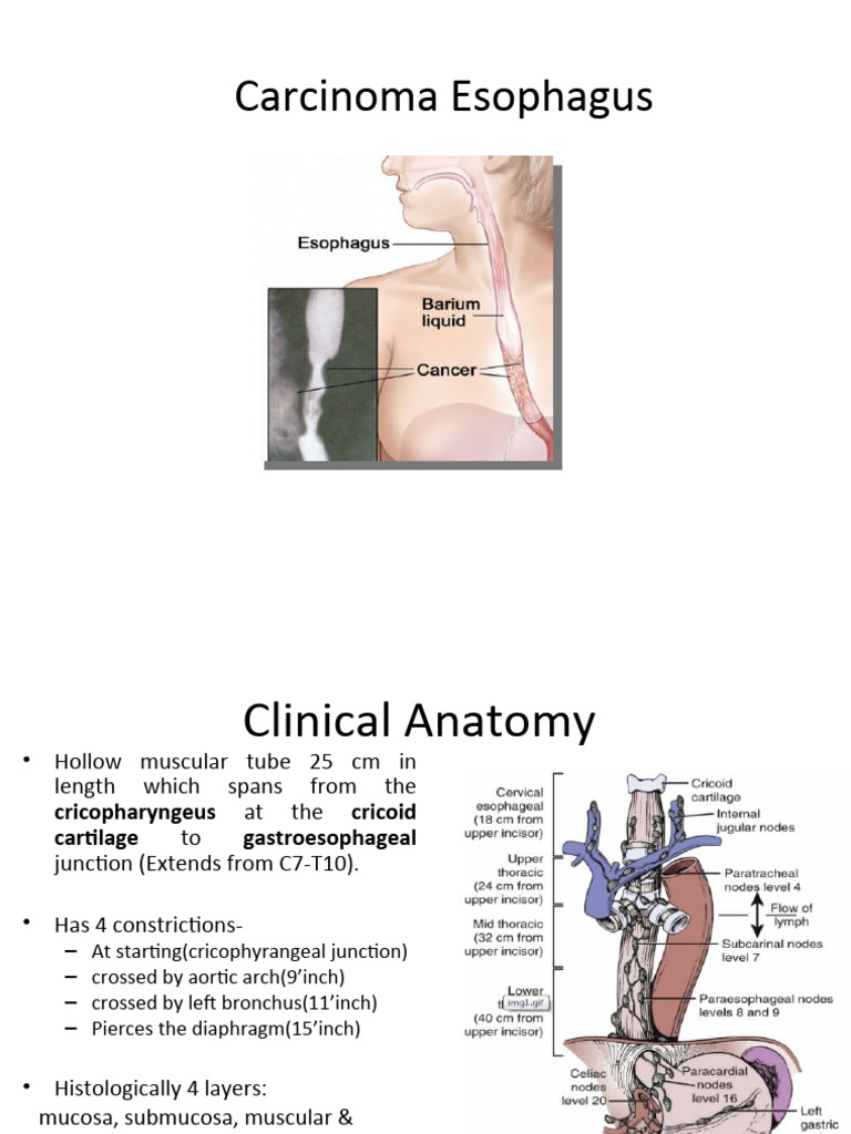 Carcinoma Oesophagus | PDF | Esophagus | Esophageal Cancer