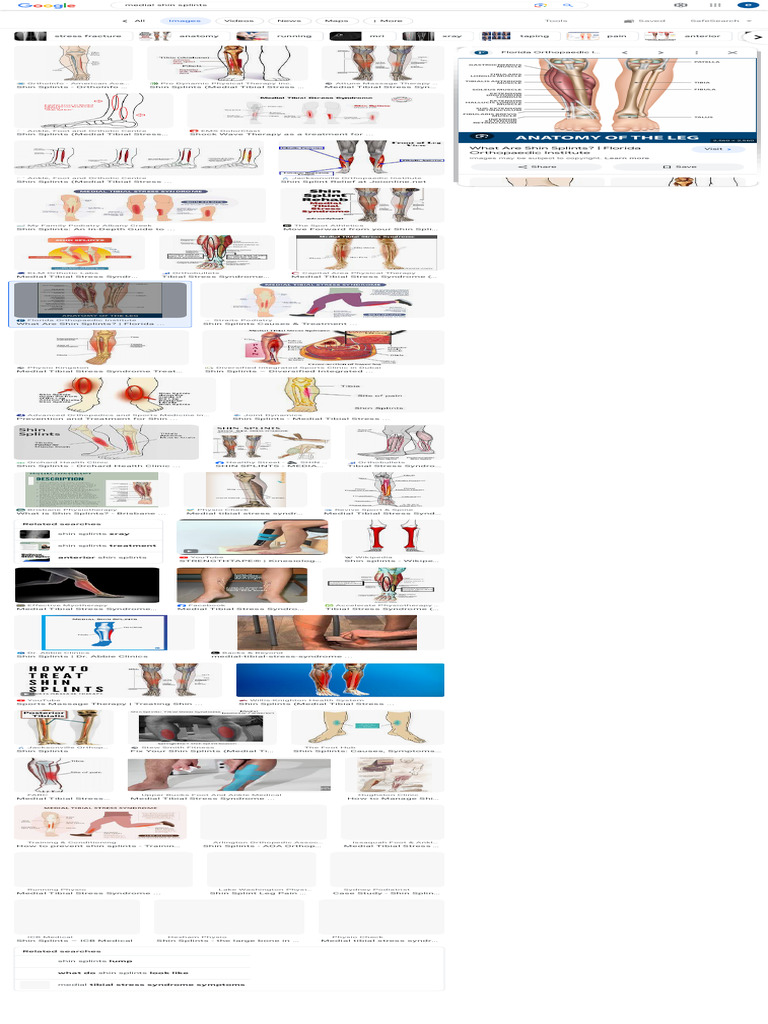 Medial Shin Splints - Google Search | PDF | Physical Therapy ...