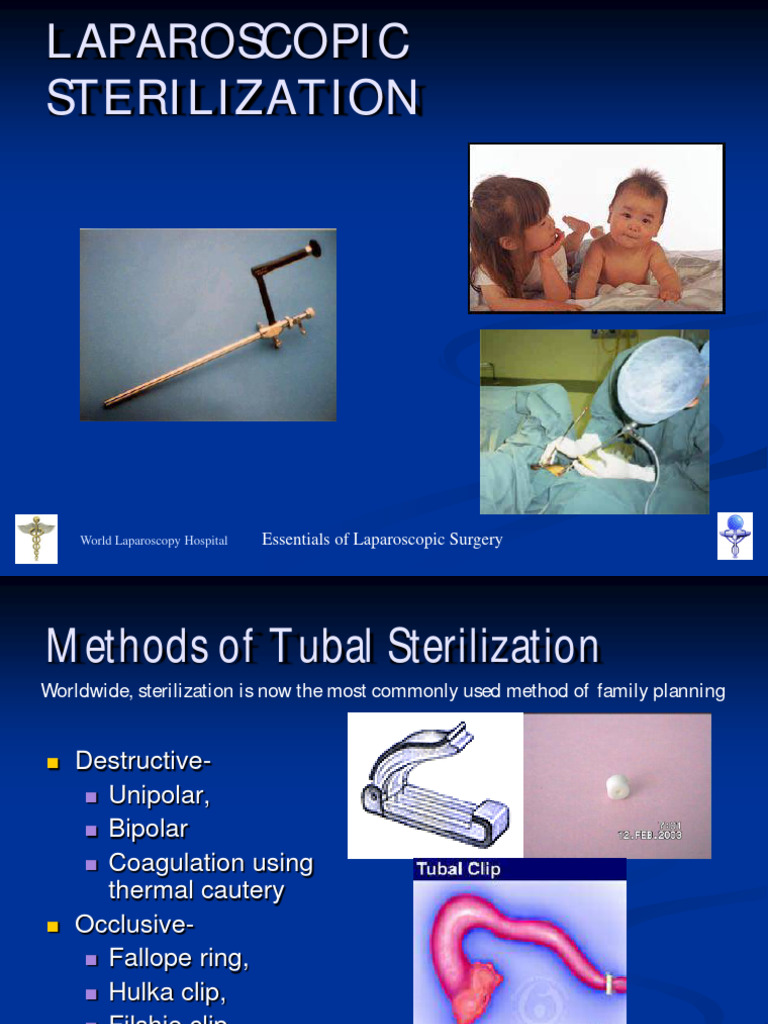 Laparoscopic Sterlization | PDF | Surgery | Neutering