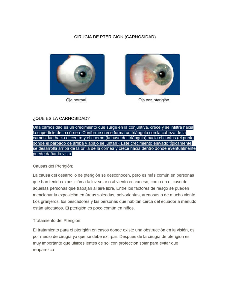 Cirugia de Pterigion | PDF | Glaucoma | Catarata