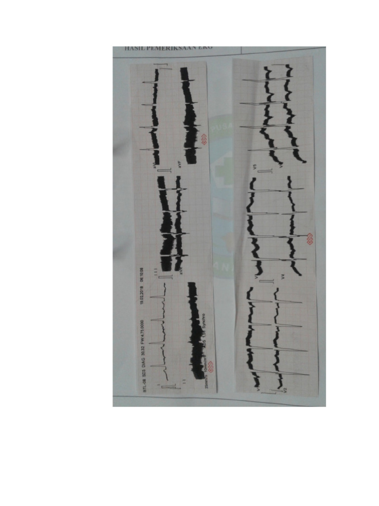 Ekg | PDF