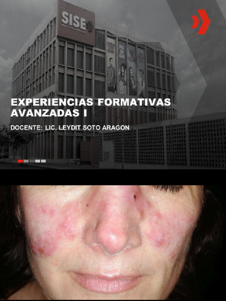 28 Lupus Eritematoso Sistemico Pdf Inmunología Epidemiología