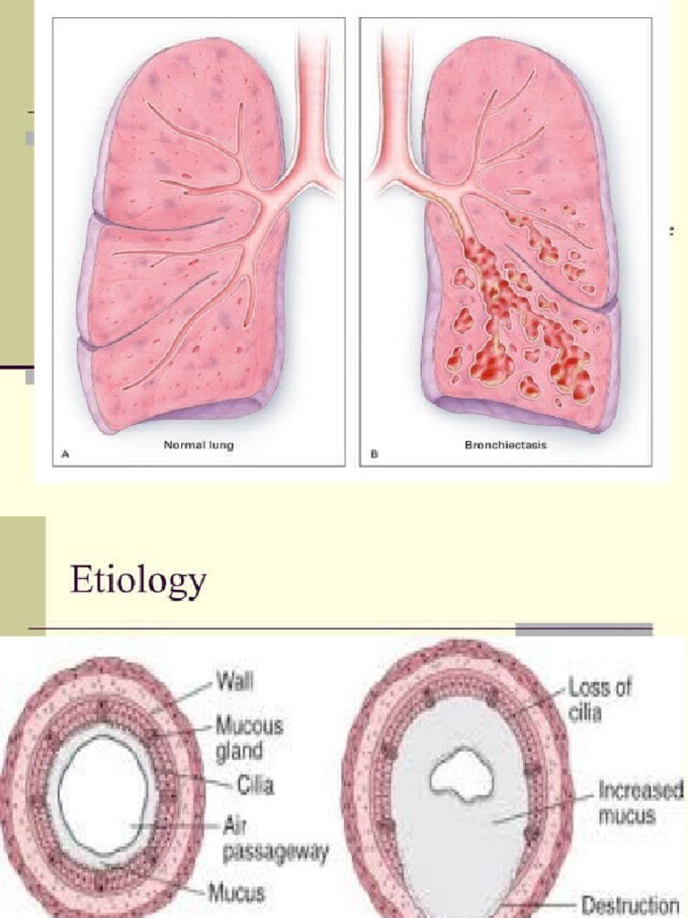 Bronchiectasis Cop D Asthma | PDF
