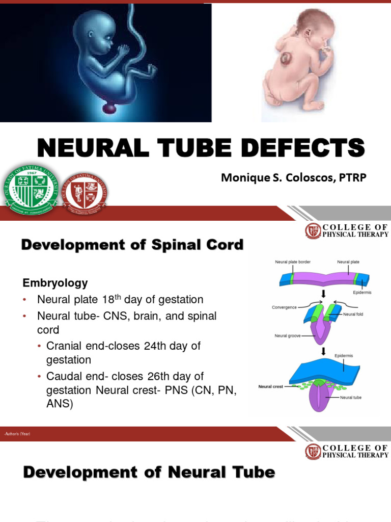 Understanding Neural Tube Defects | PDF | Clinical Medicine | Human ...