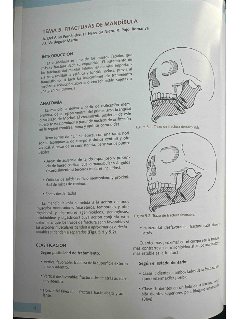 Fracturas Mandibulares | PDF