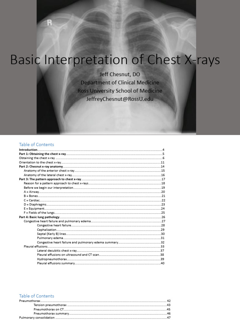 Chest X-ray Interpretation Basics | PDF | Lung | Ct Scan