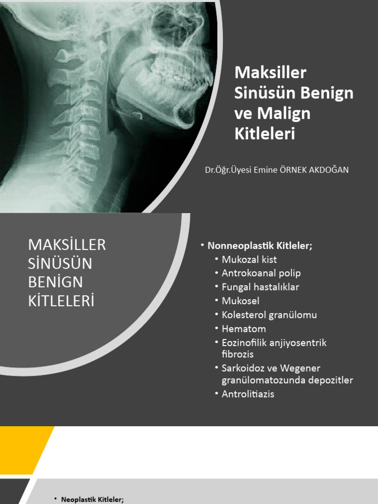 5.maksiller Sinüsün Benign Ve Malign Kitleleri | PDF