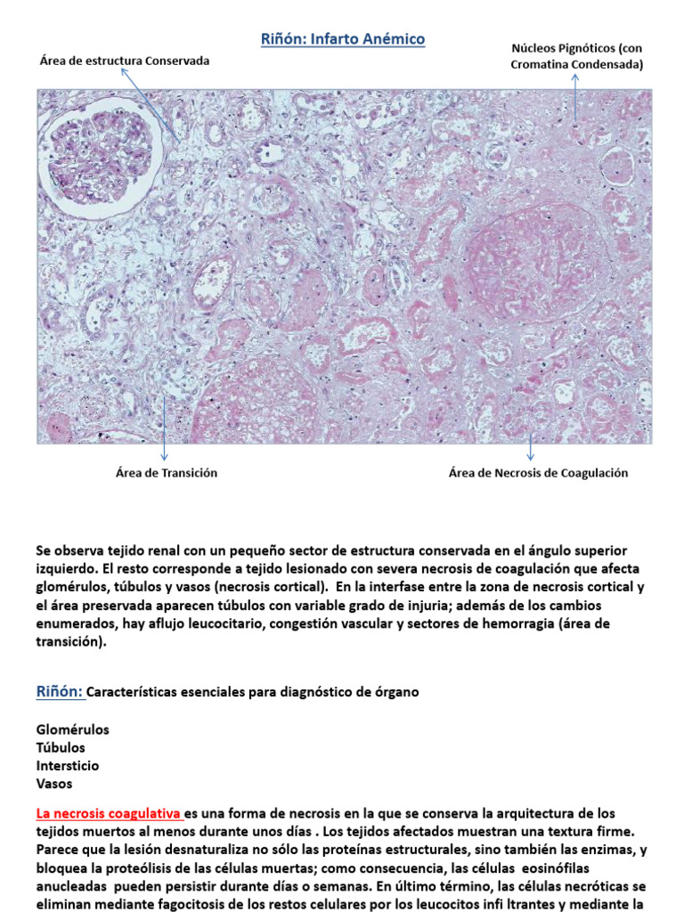 Necrosis Coagulativa en Riñón | PDF | Biología Celular) | Páncreas