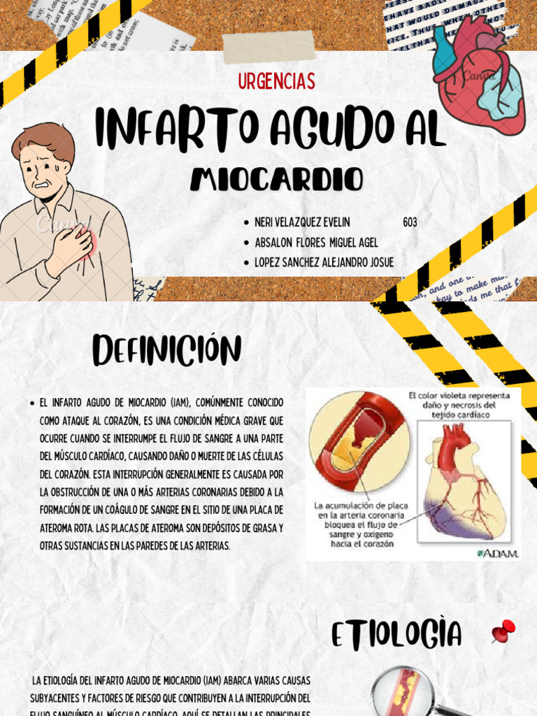Infarto Agudo Al Miocardio | PDF | Trombosis | Infarto de miocardio