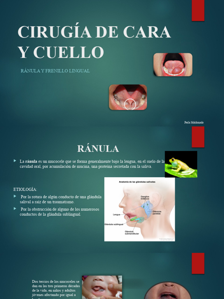 Ránula y Frenillo Lingual: Diagnóstico y Tratamiento | PDF | Medicina ...