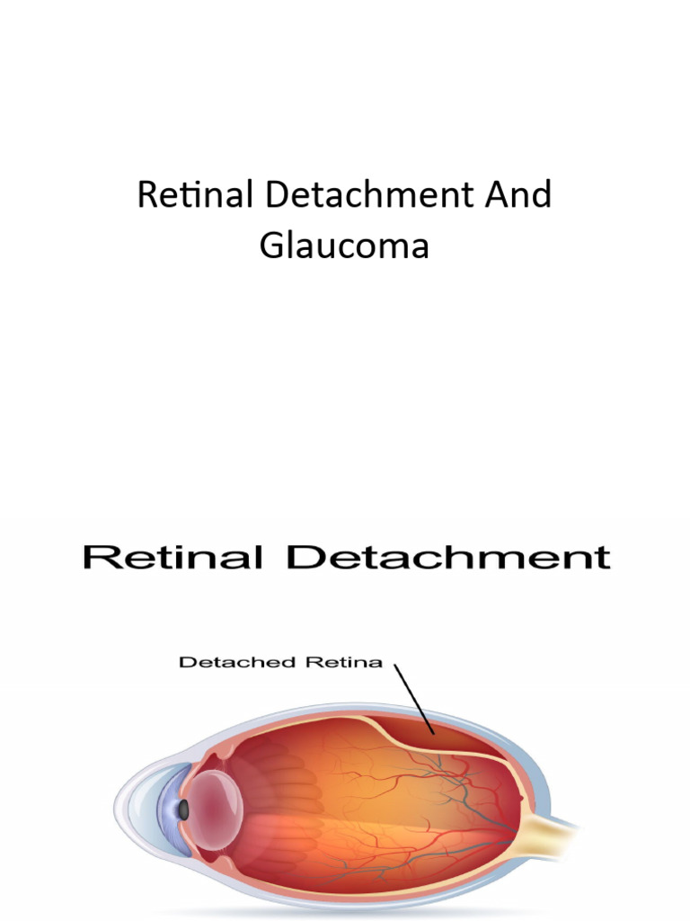 Glaucoma and Retinal Detachment Overview | PDF | Glaucoma | Retina